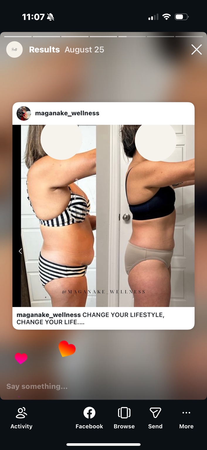Client side-view comparison in a striped swimsuit and black bra